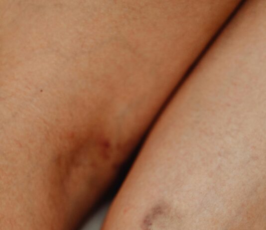 The Role Of Art Therapy In Trauma Recovery: Unlock Healing Power